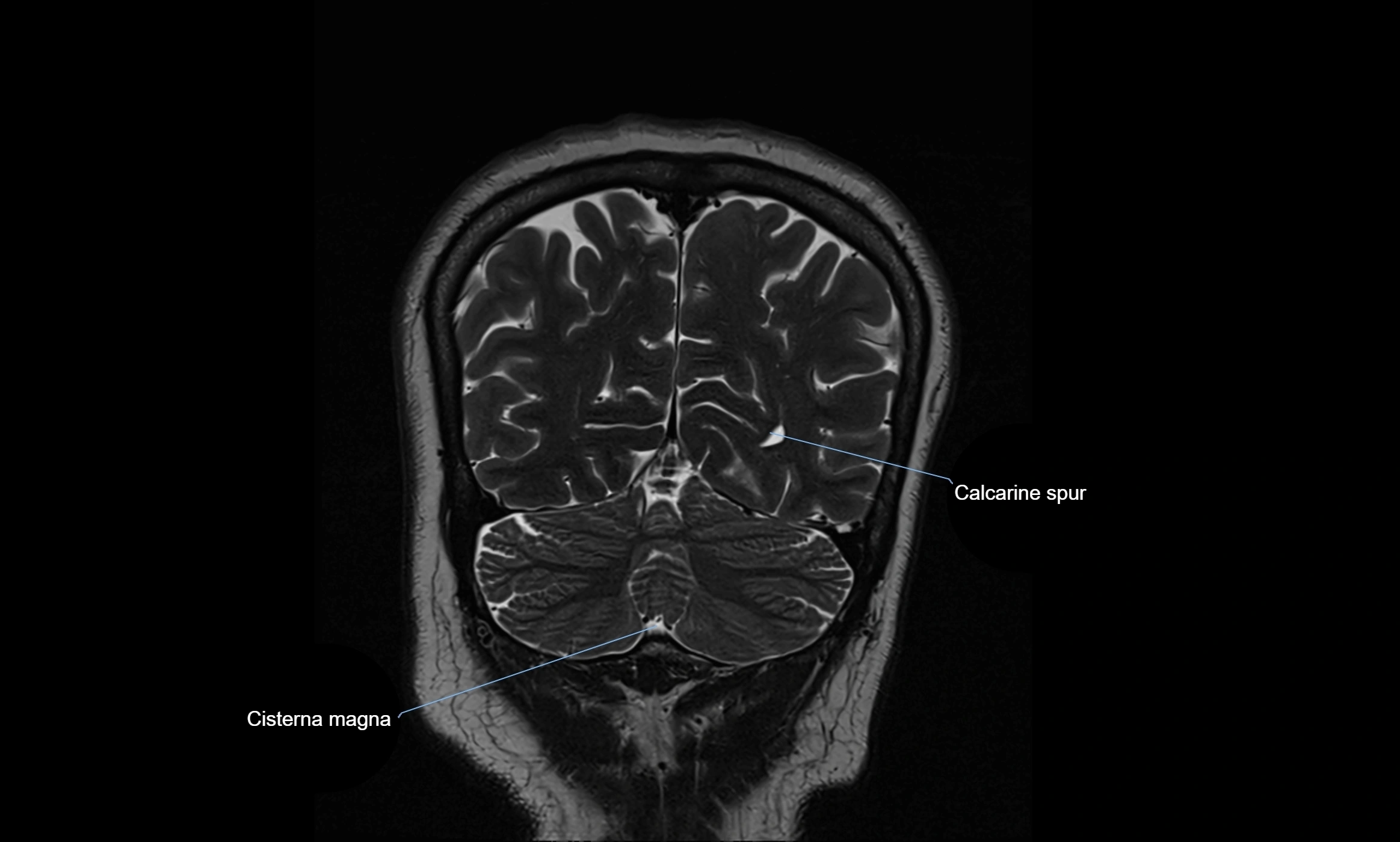 Brain cisterns  and ventricles coronal anatomy 3T MRI image-img-00001-00050.webp
